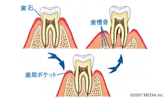 奥歯の場合